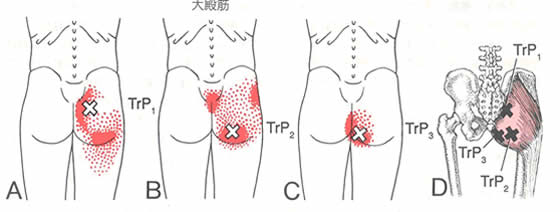 トリガーポイントが原因で発生する痛みやシビレの代表例 世田谷カイロプラクティック整体院 女性特有の症状に強い千歳烏山整体